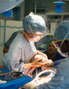 cesarean birth